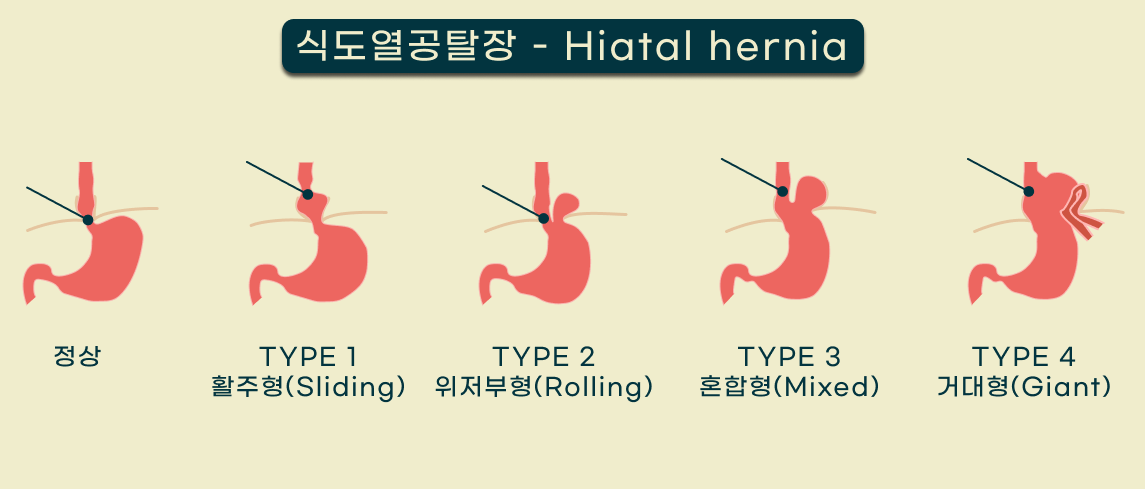 식도열공탈장.png