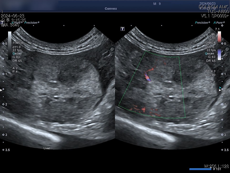 Color Doppler