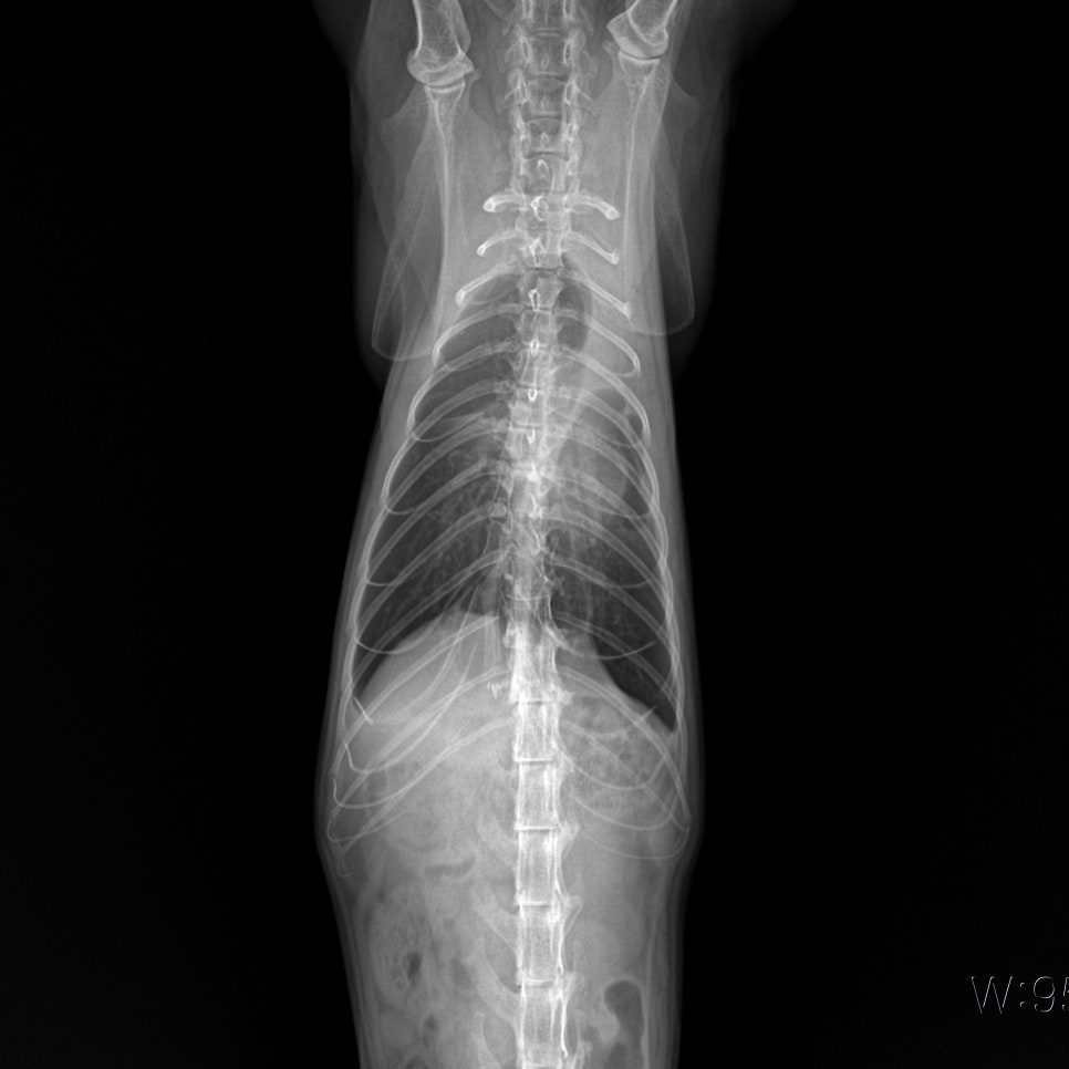 수술 후 흉부 VD X-ray