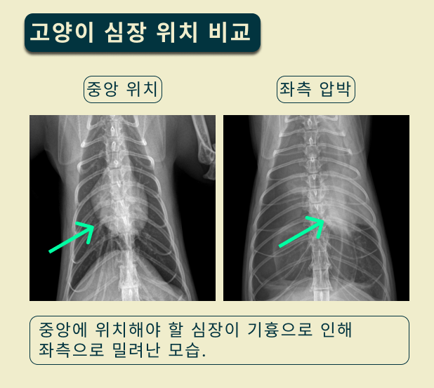 심장 위치 비교 다이어그램