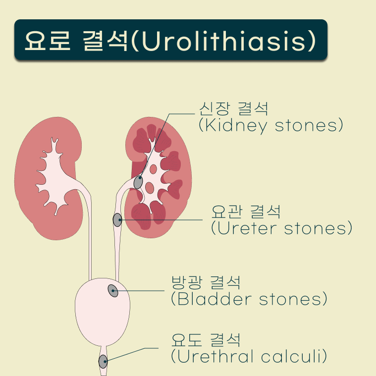 요로 결석의 위치별 분류 도식