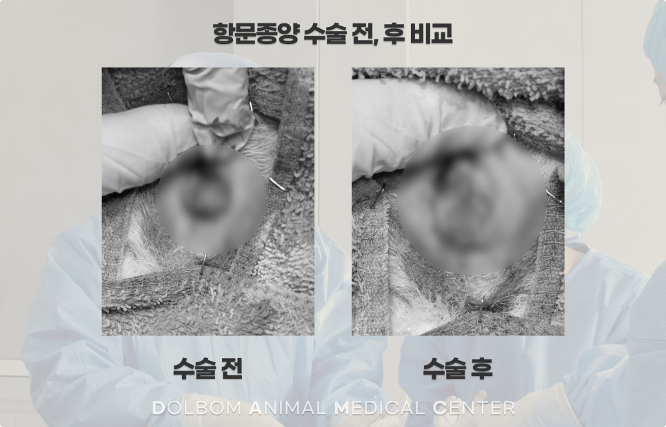 항문 주위 수술 전후를 비교한 원문 사진 카드. 민감 부위는 흐림 처리됨