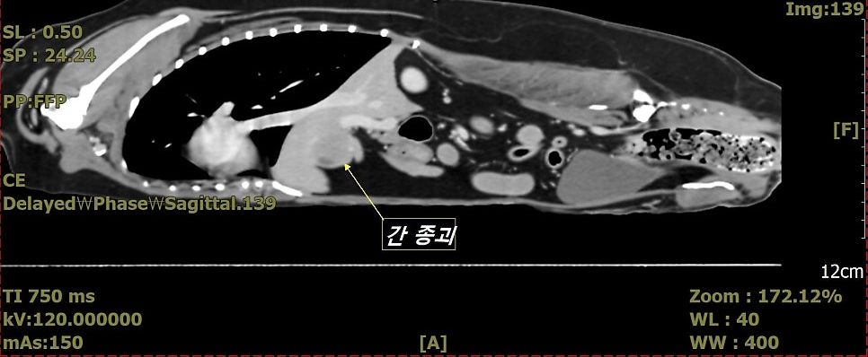 간 네모엽 종괴의 시상면 CT
