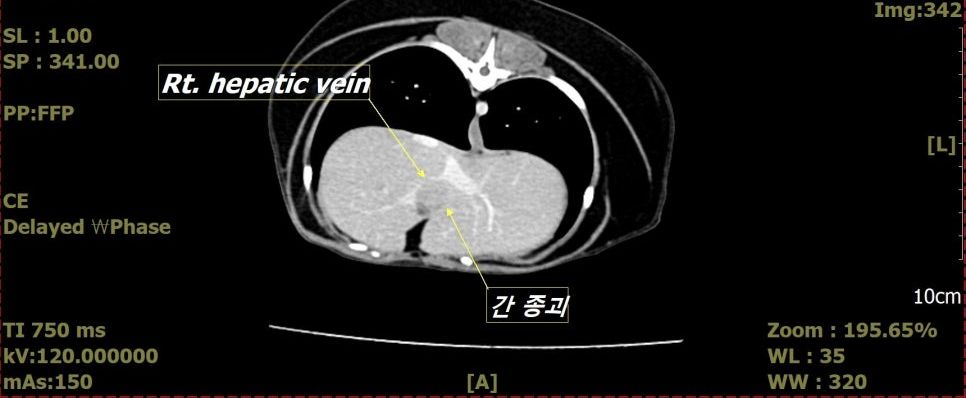 간 종괴와 우측 간정맥의 위치를 표시한 CT