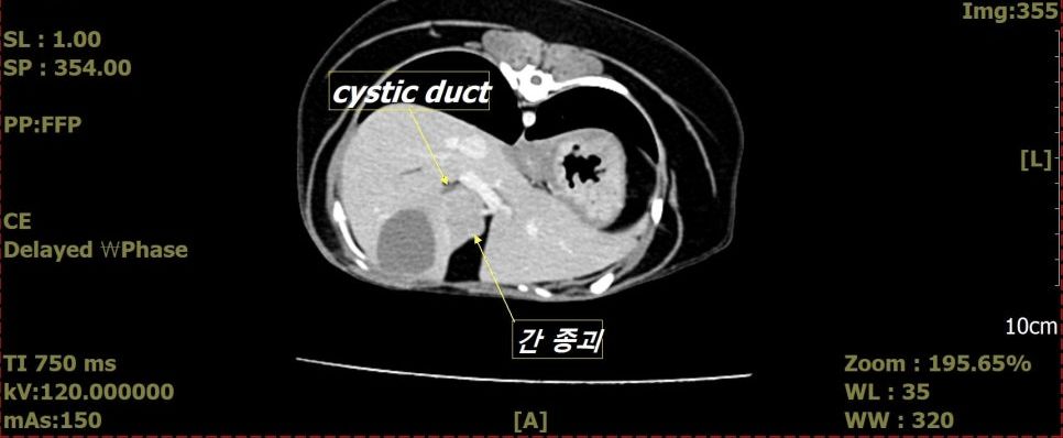 간 종괴와 낭관의 위치를 표시한 CT