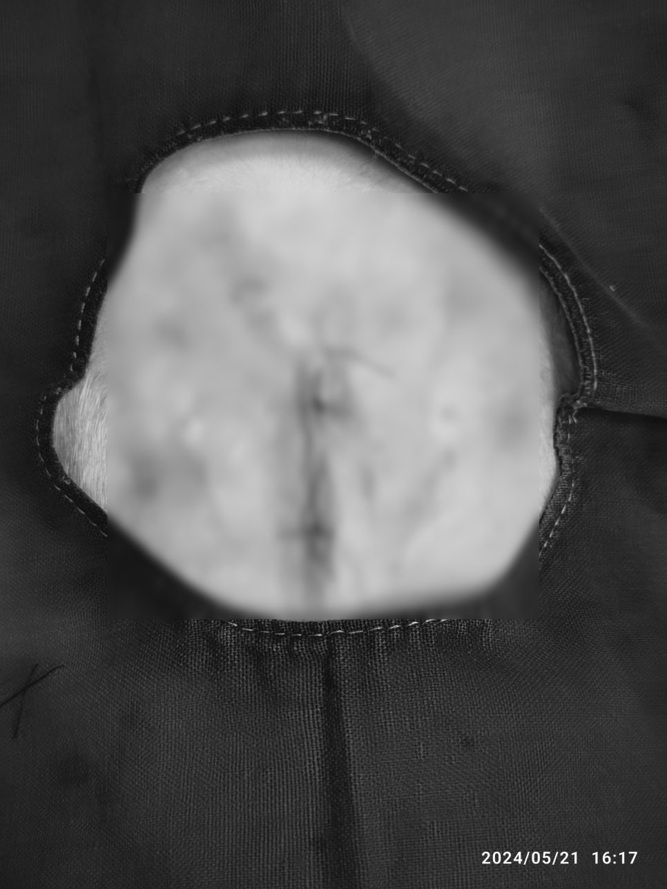 이중 봉합 완료
