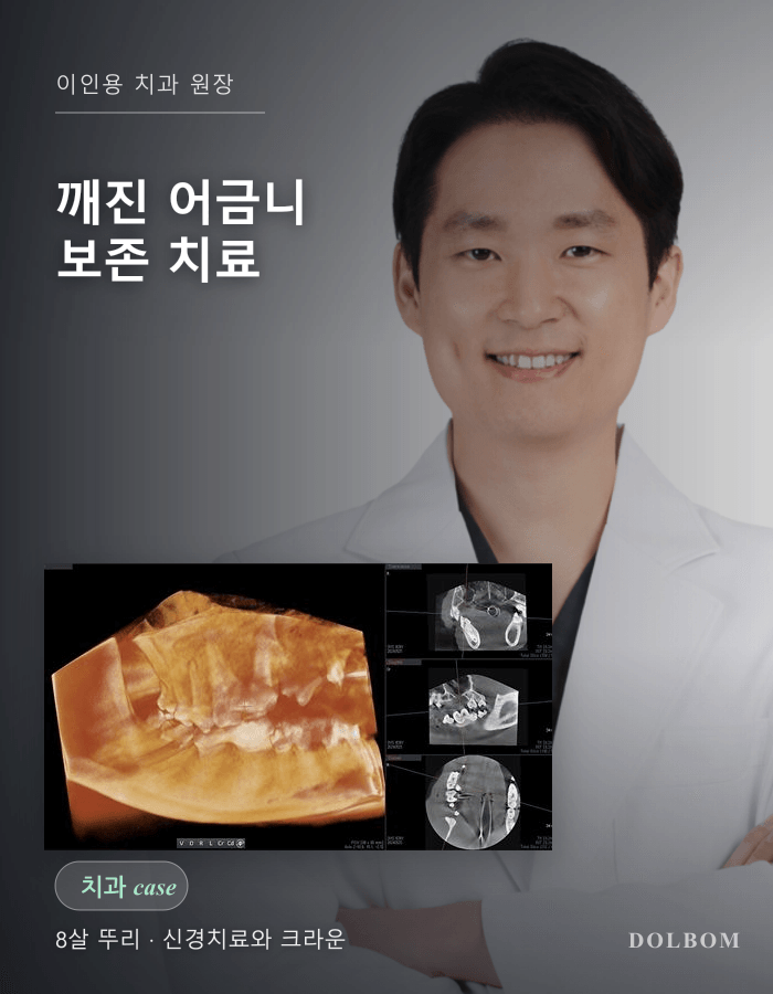 강아지 어금니 파절, 8살 뚜리의 신경치료와 크라운 수복-thumbnail