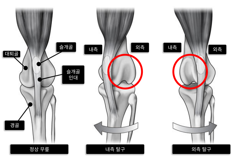 정상 무릎과 내측·외측 슬개골 탈구 위치를 비교한 원문 그림