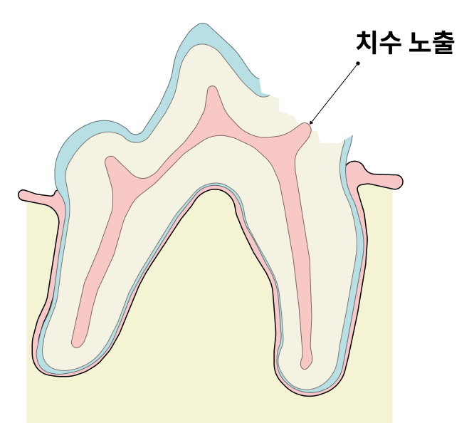 깨진 치관을 통해 치수가 노출되는 모습을 표시한 단면도