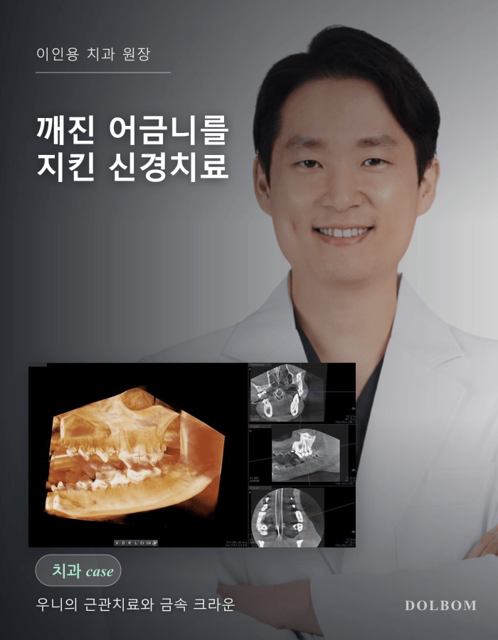 강아지 치아 파절, 신경치료와 크라운으로 어금니를 지킨 우니-thumbnail
