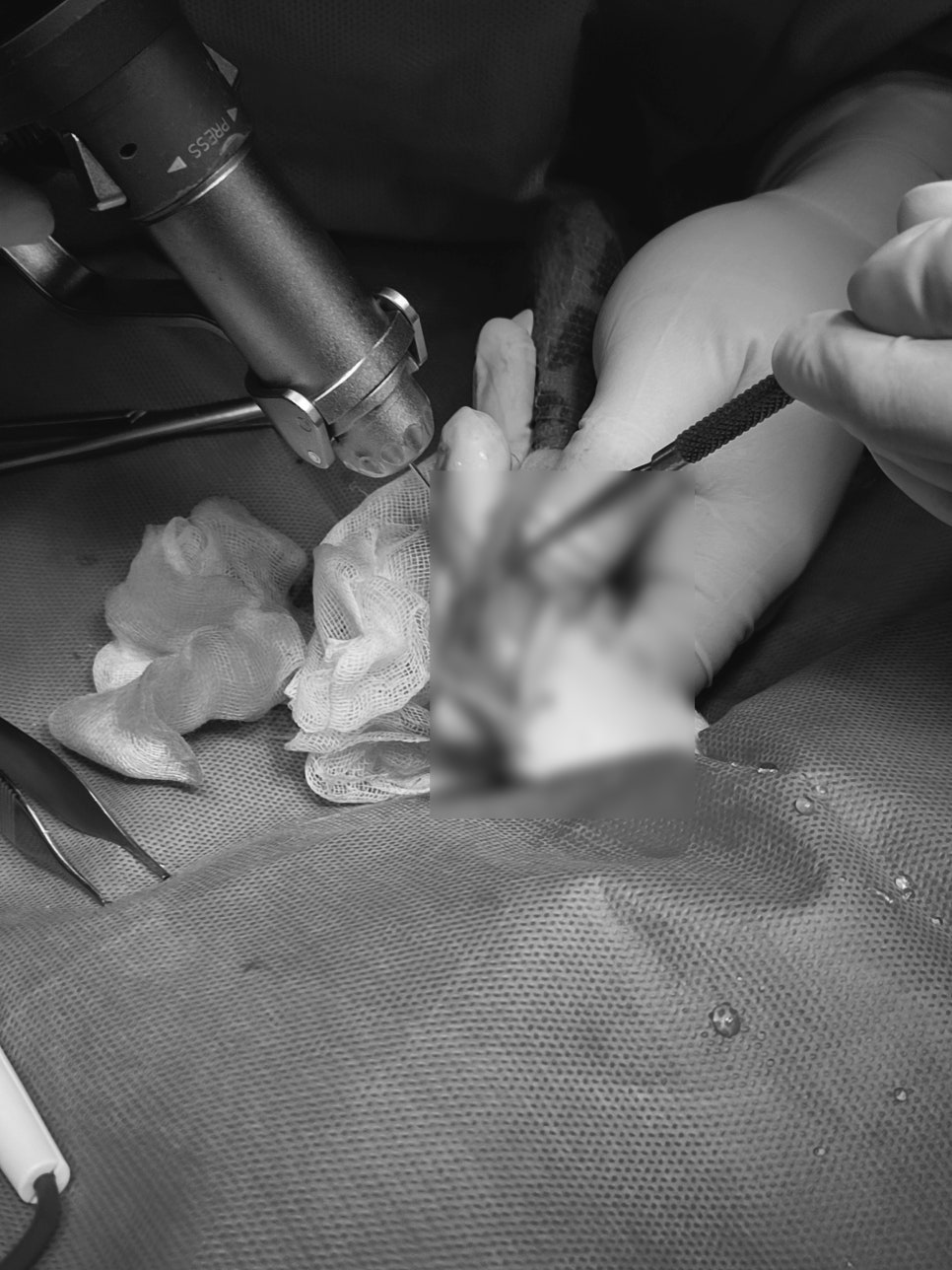 K-wire 삽입 - 드릴 작업