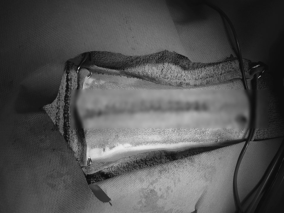 수술을 마치고 닫힌 피부선