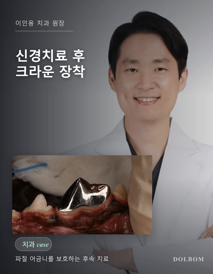강아지 신경치료 후 크라운 장착, 파절 어금니를 보호한 후속 치료-thumbnail