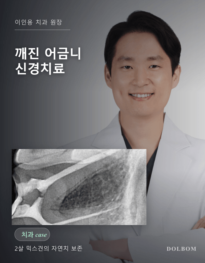 강아지 어금니 파절, 2살 믹스견의 신경치료와 레진 수복-thumbnail