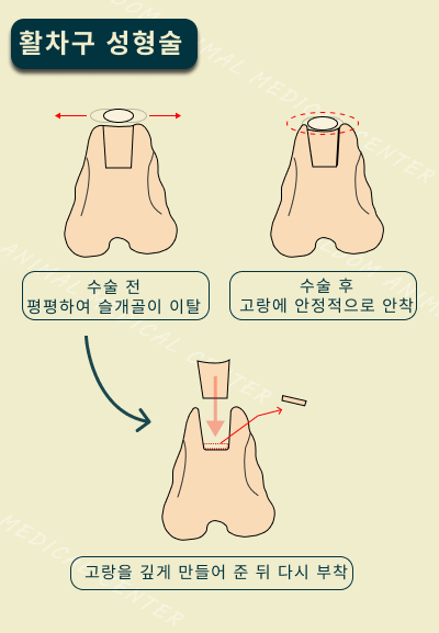 활차구 성형술.png