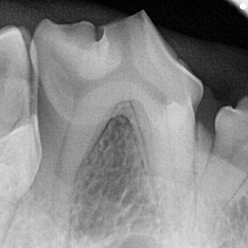 치과 X-ray 술전