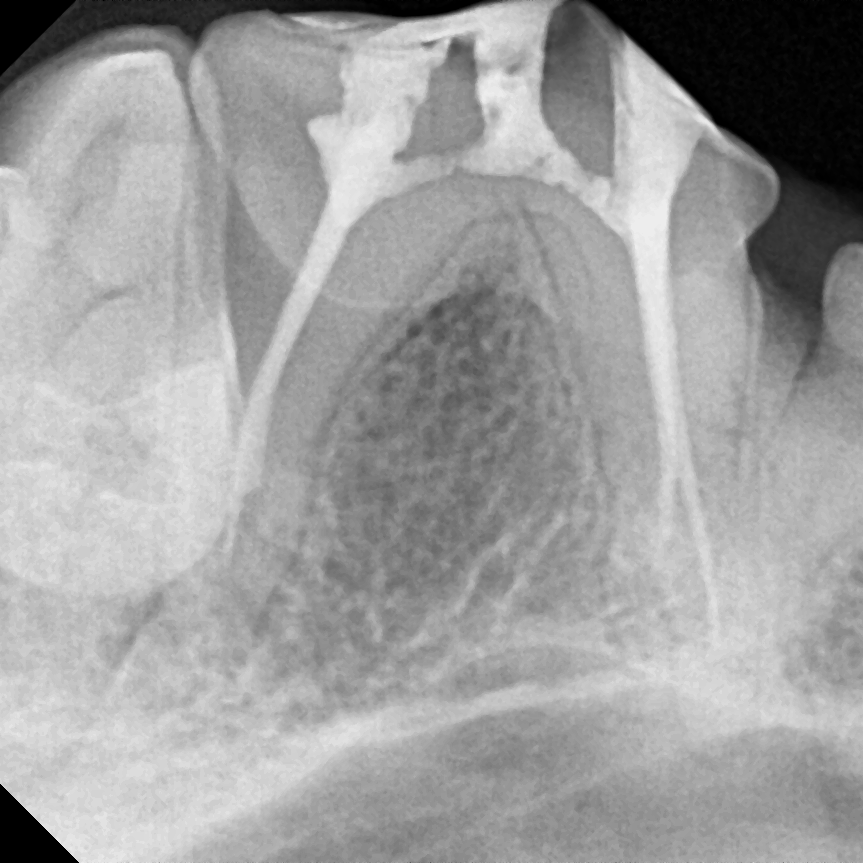 치과 X-ray 술후