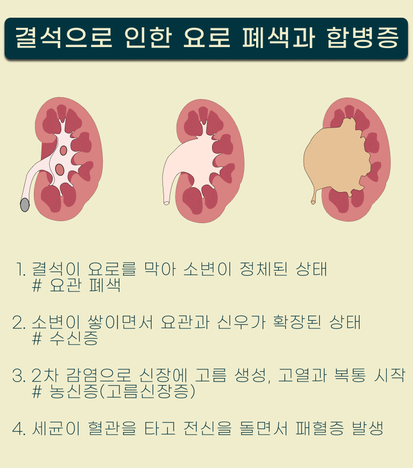 결석으로 인한 요관 폐색과 합병증.png