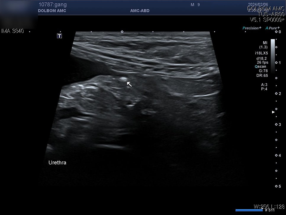 초음파 — 요도(Urethra) 결석 확인