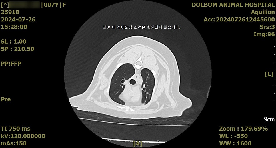 흉부 CT - 폐 전이 평가