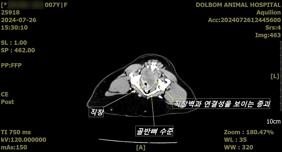 골반 횡단면 CT - 직장벽 연결