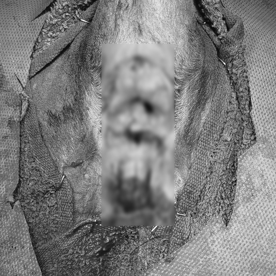 직장 단단봉합 (anastomosis)