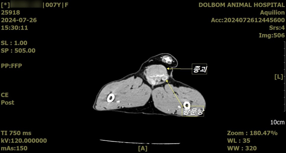 골반강 CT - 종괴와 항문낭
