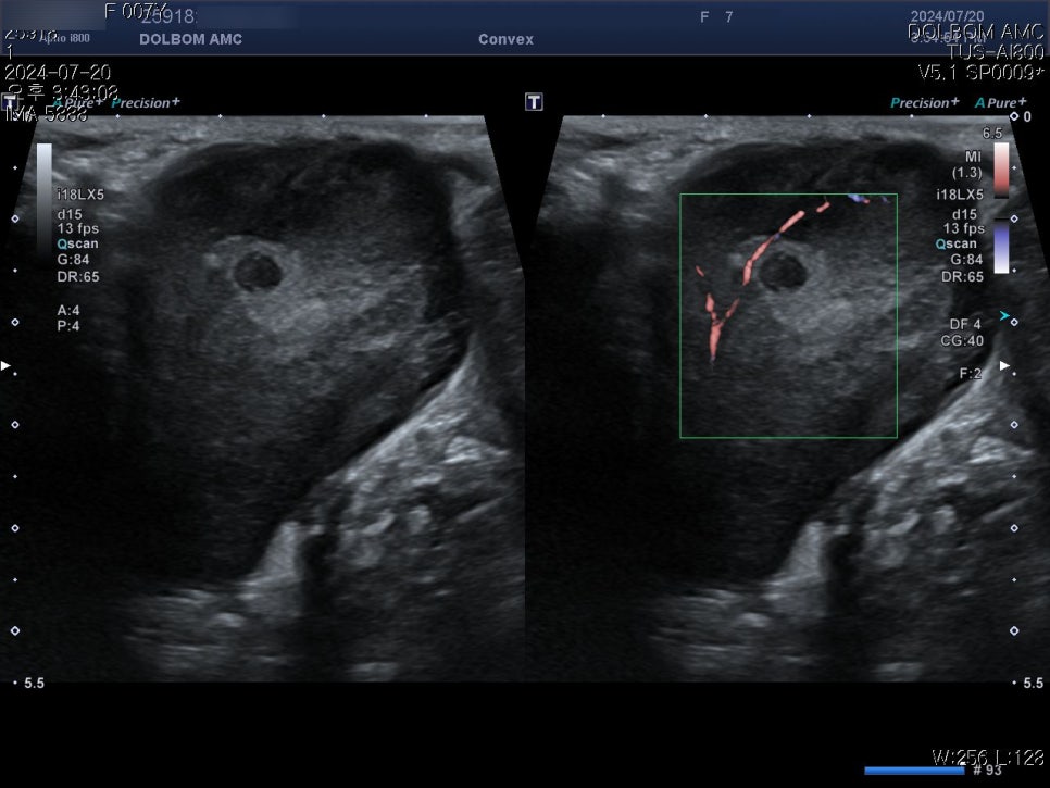 복부 초음파 + Color Doppler