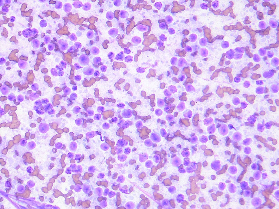 FNA cytology - H&E 염색