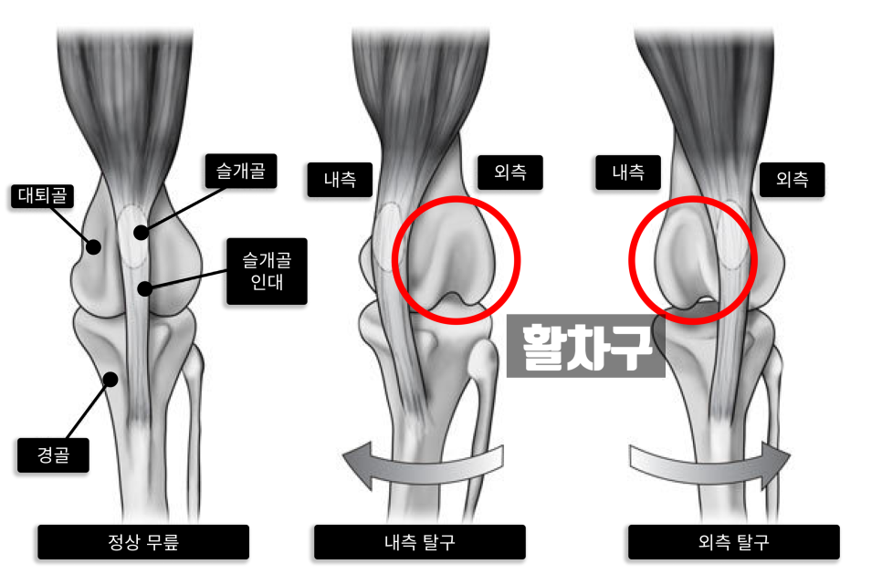 정상 무릎 vs 내측·외측 탈구