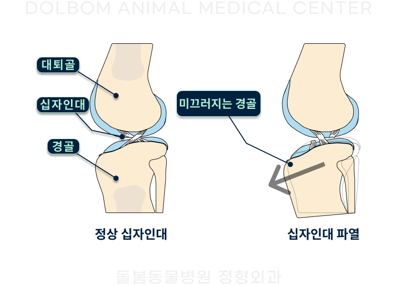 정상과 파열된 앞십자인대를 비교한 설명 그림