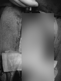 수술 중 복부 주변의 거즈와 손, 중앙 부분이 가려진 사진