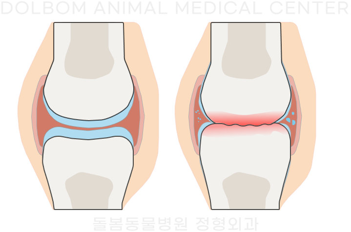 정상 무릎과 관절염이 있는 무릎을 비교한 원문 설명 그림