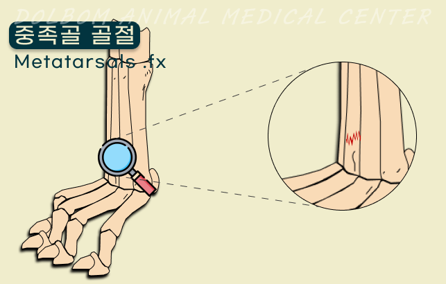 세 번째 중족골 골절 위치를 표시한 해부 그림